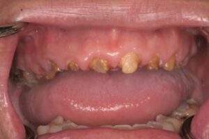 Miami Beach cosmetic dentist