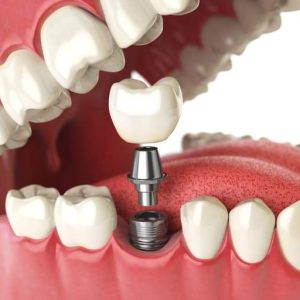 Miami Beach cosmetic dentist